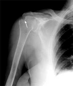 X-ray of previously dislocated shoulder